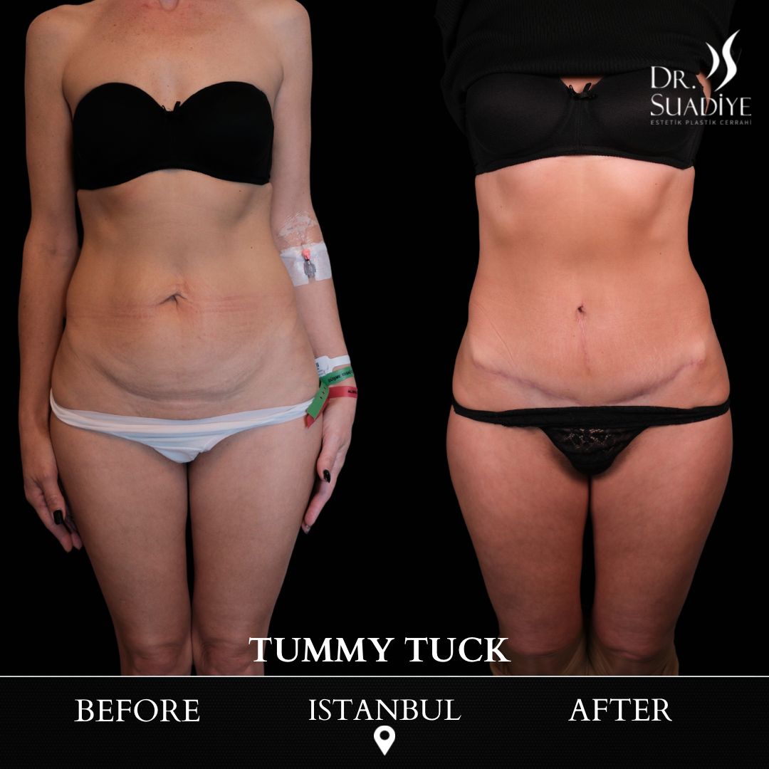 Tummy Tuck in Turkey