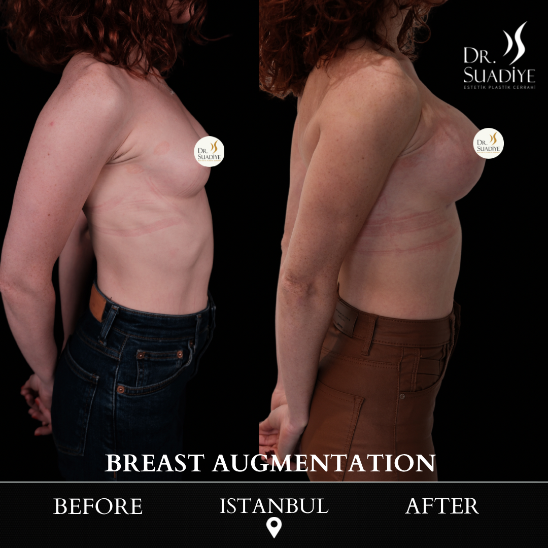 Breast Augmentation in Turkey