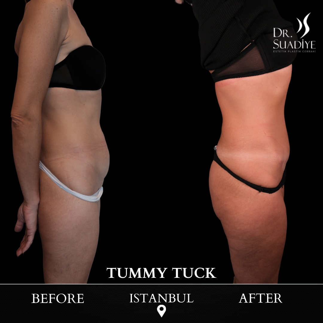 Tummy Tuck in Turkey