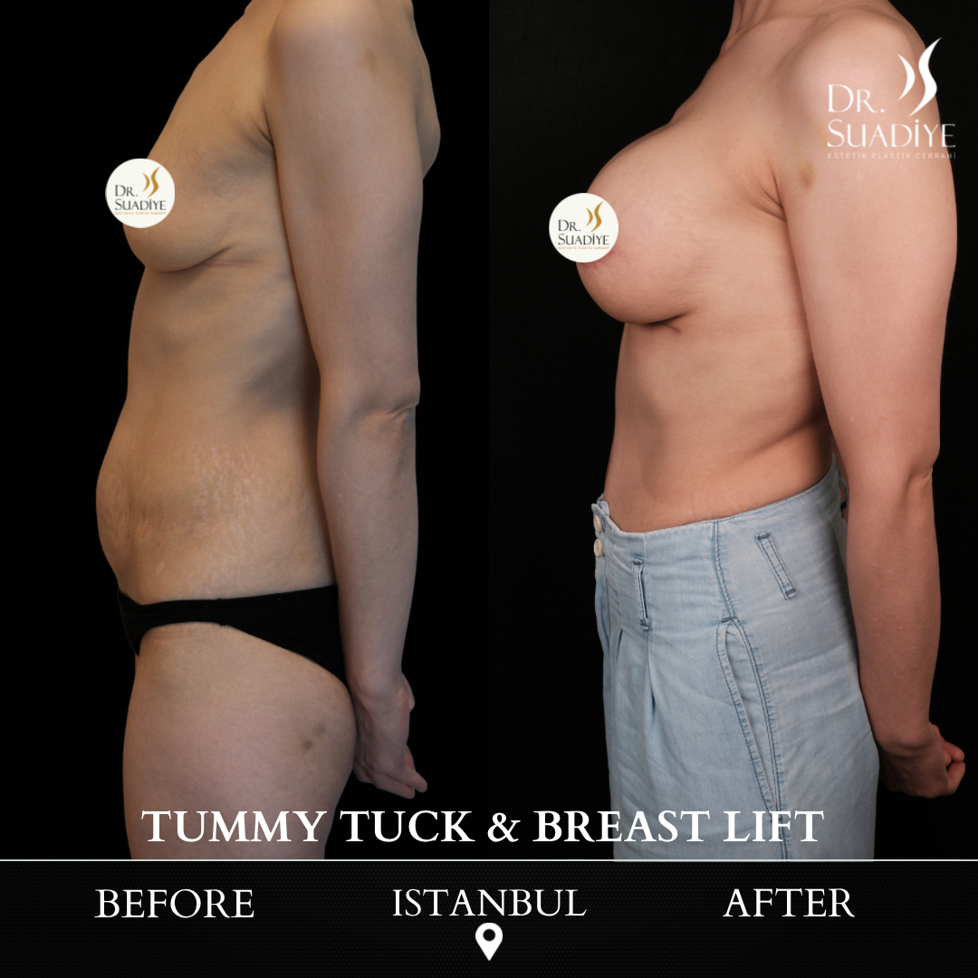 Mommy Makeover in Turkey