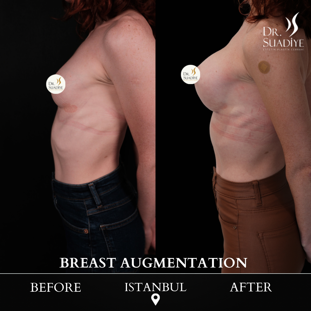 Breast Augmentation in Turkey