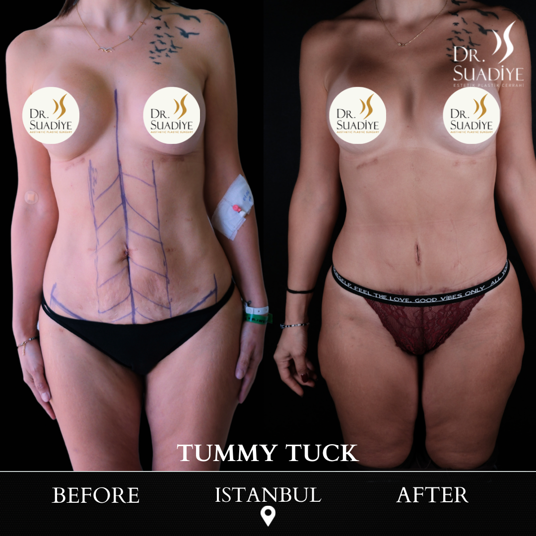 Tummy Tuck in Turkey
