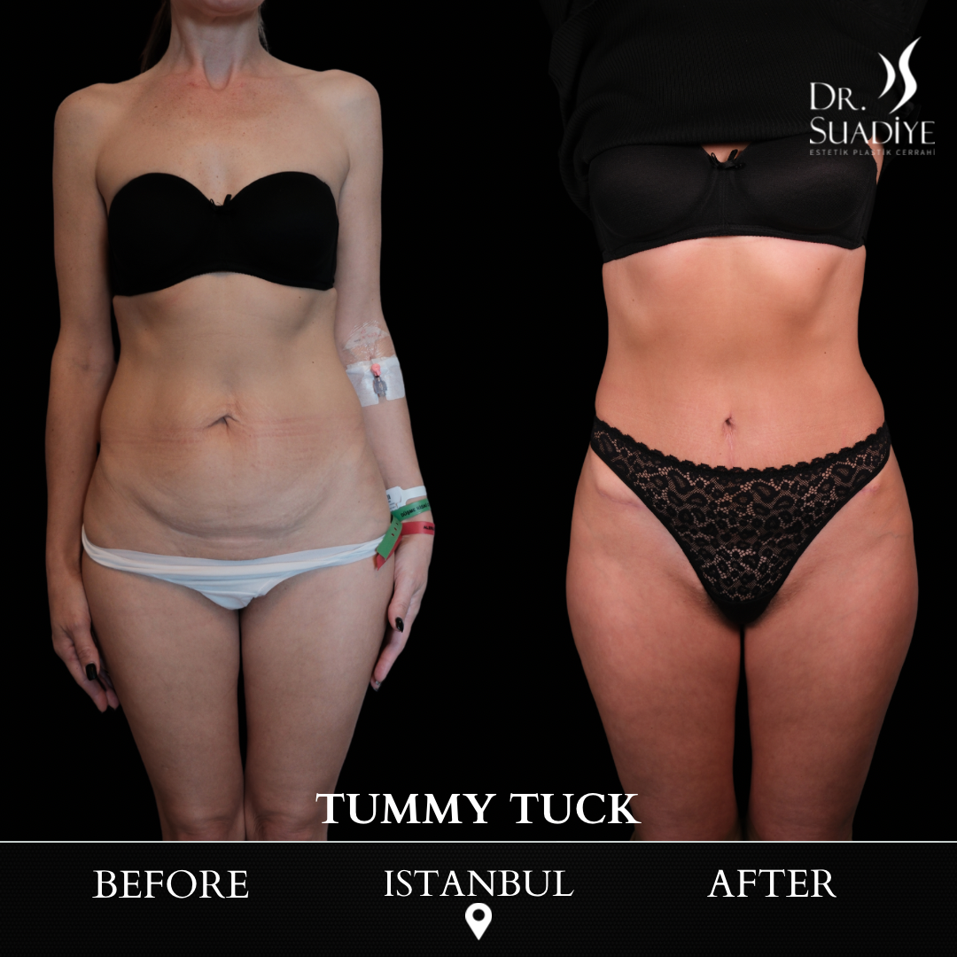 Tummy Tuck in Turkey