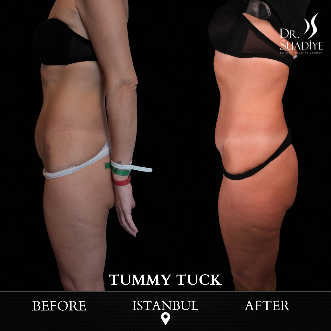 Tummy Tuck in Turkey
