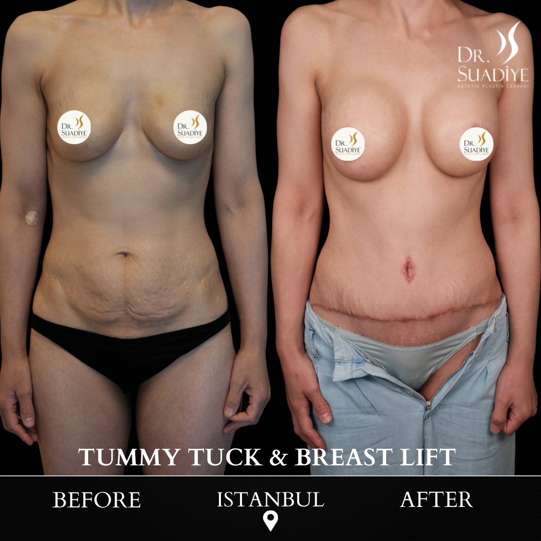 Mommy Makeover in Turkey