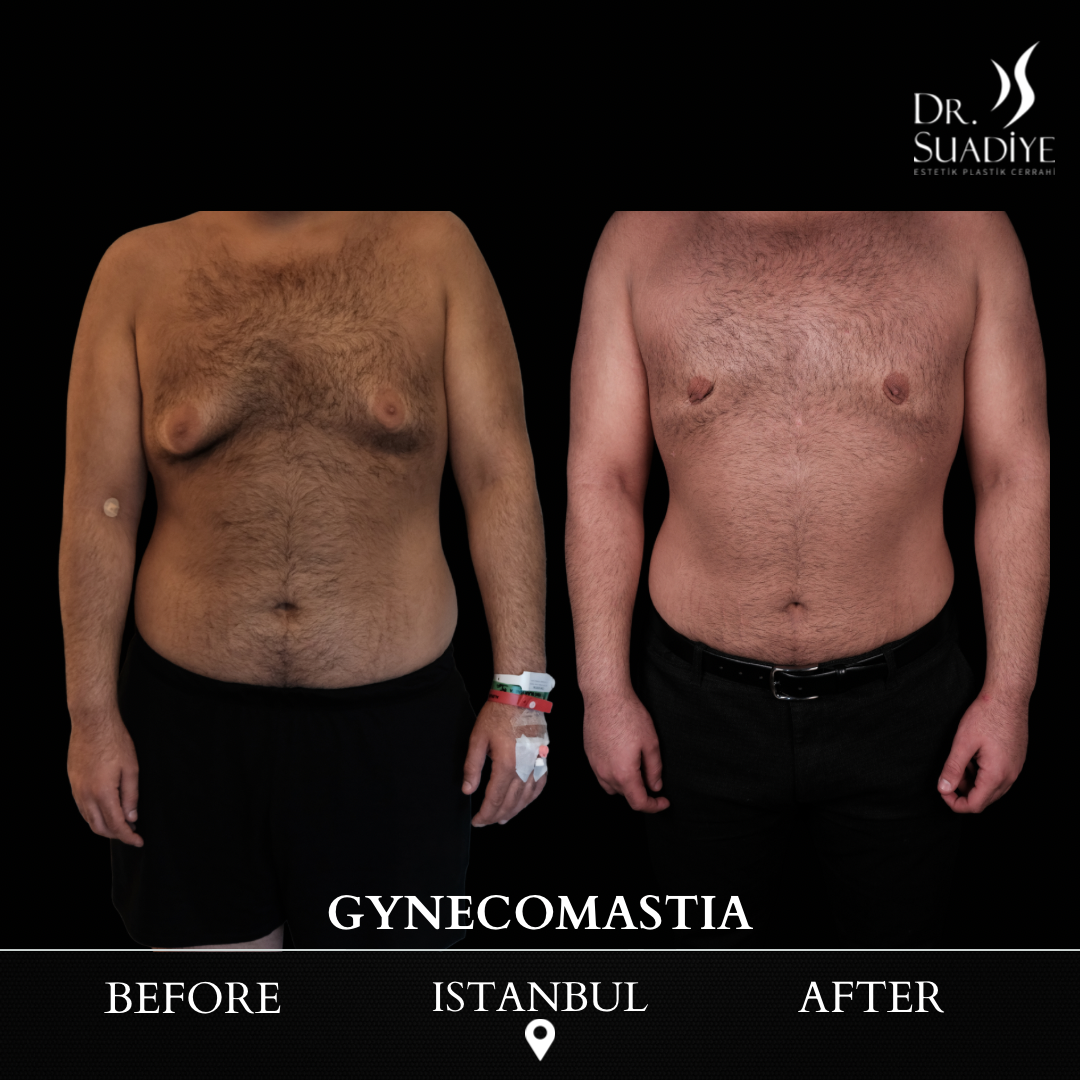 Gynecomestia in Turkey