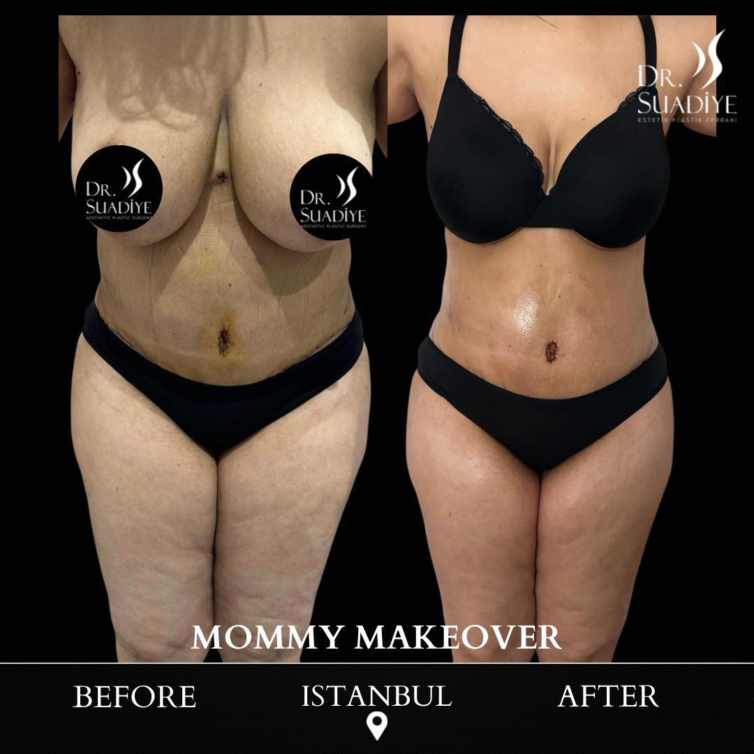 Mommy Makeover in Turkey