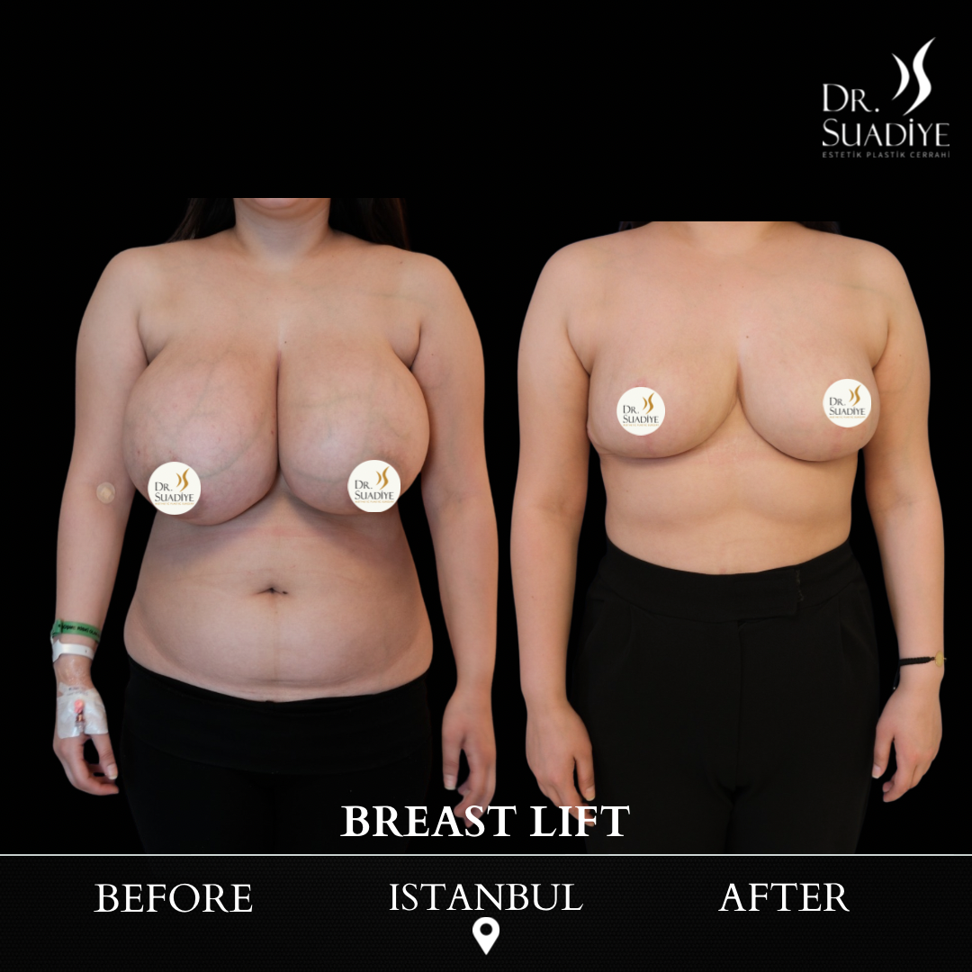 Breast Lift in Turkey