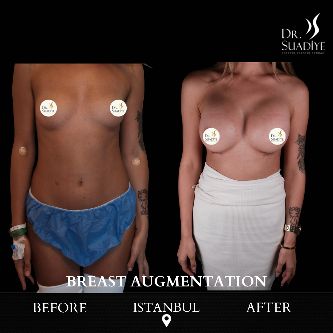 Breast Augmentation in Turkey