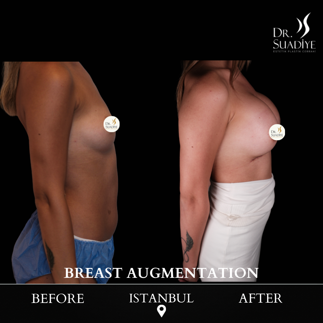 Breast Augmentation in Turkey