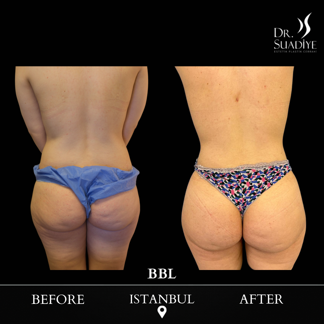 Brazillian Butt Lift - BBL in Turkey
