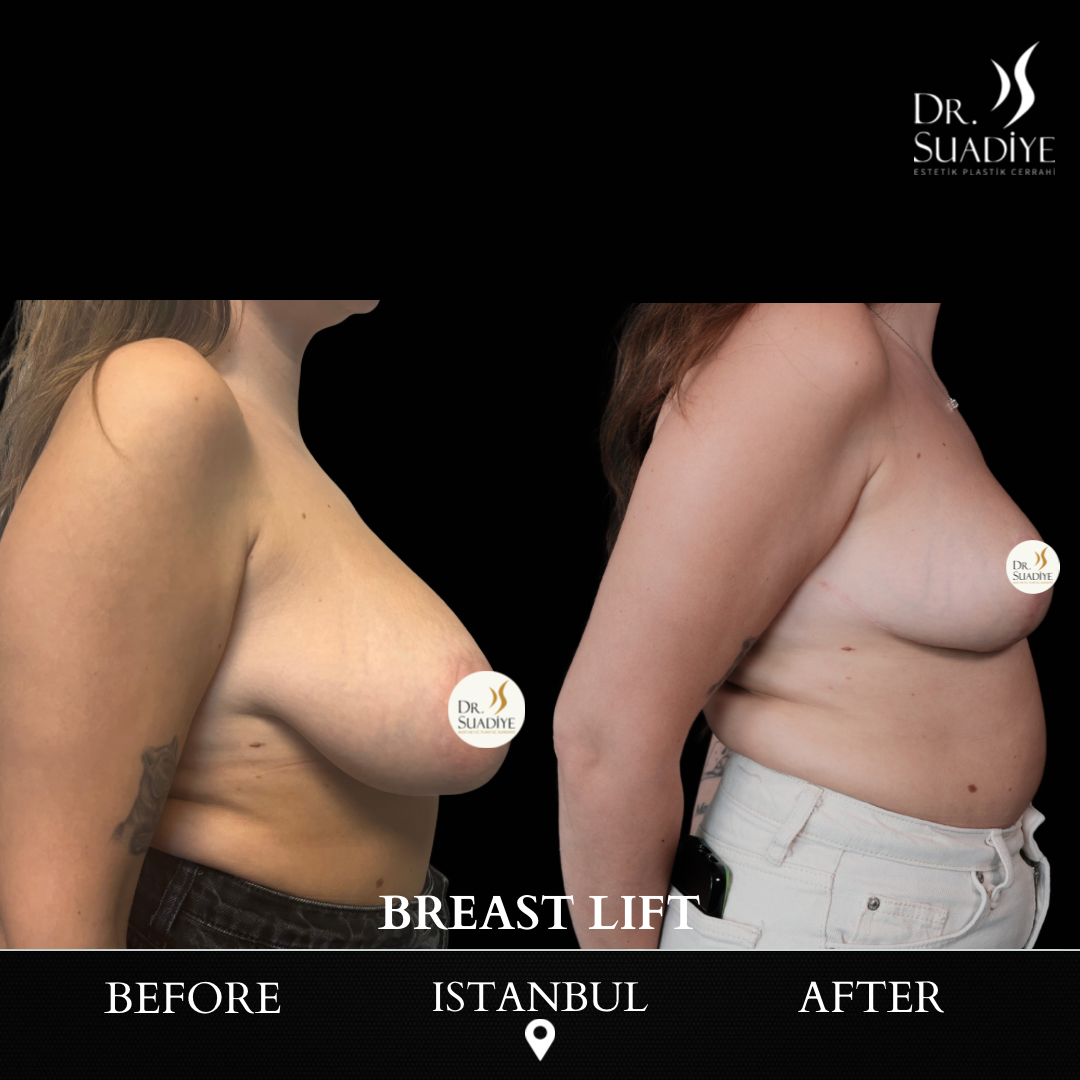 Breast Lift in Turkey