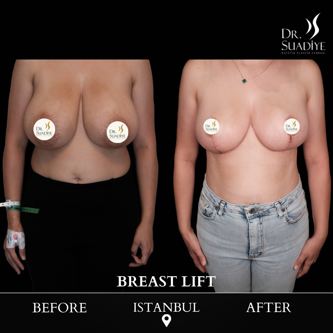 Breast Lift in Turkey
