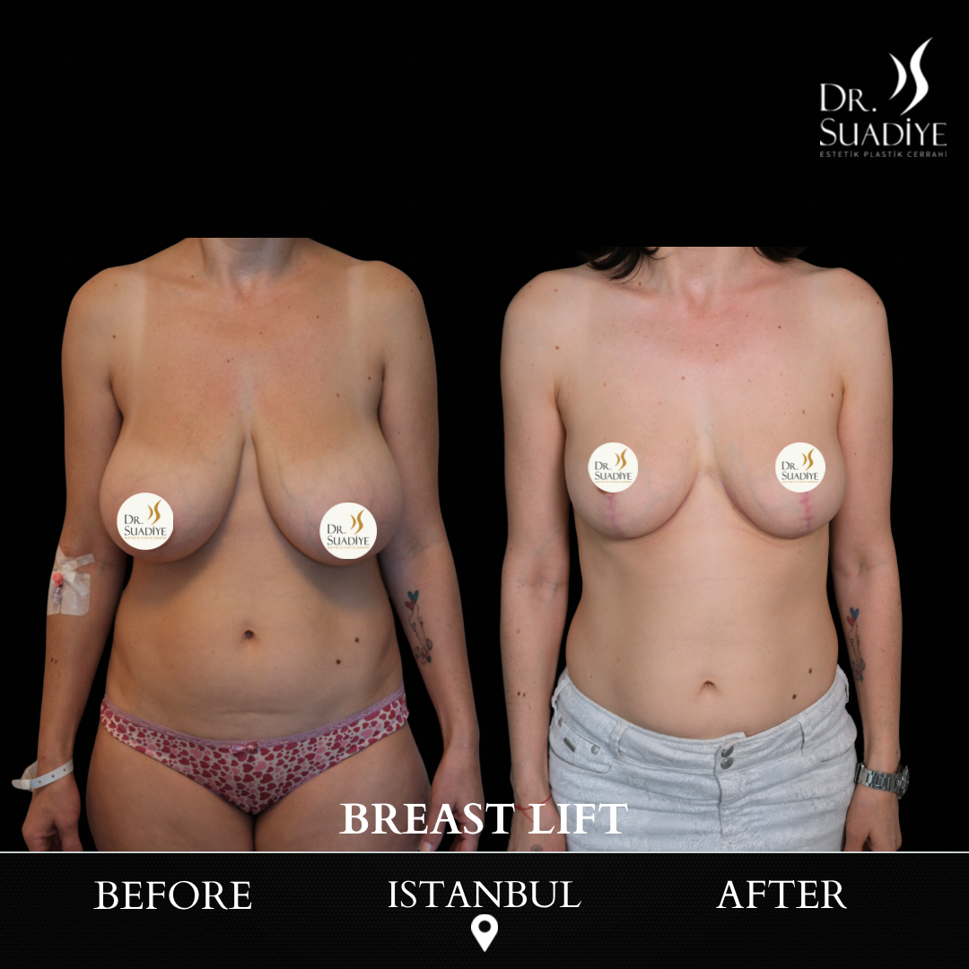 Breast Lift in Turkey