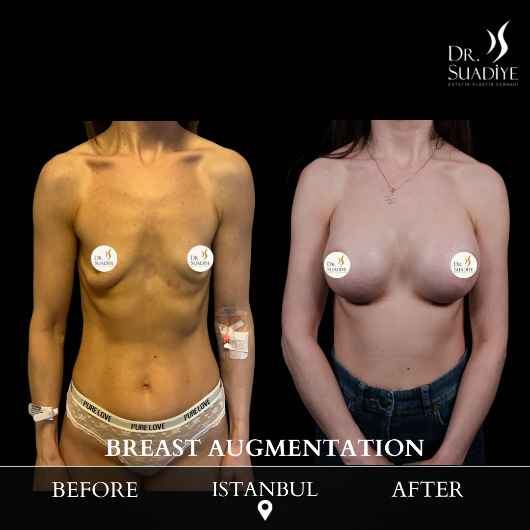 Breast Augmentation in Turkey