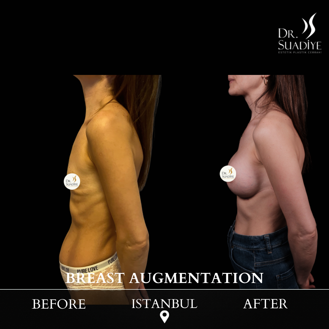 Breast Augmentation in Turkey