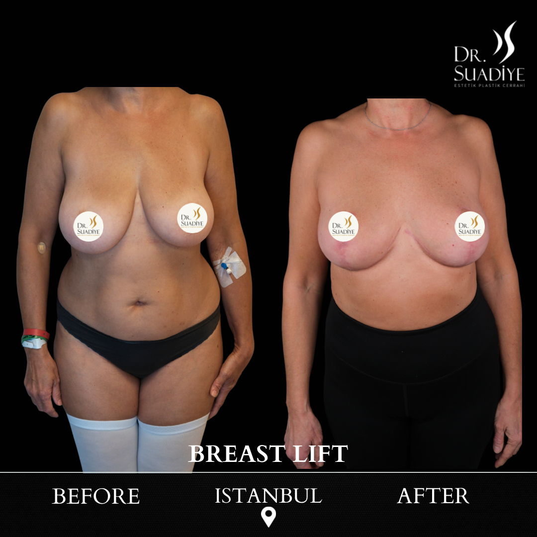 Breast Lift in Turkey