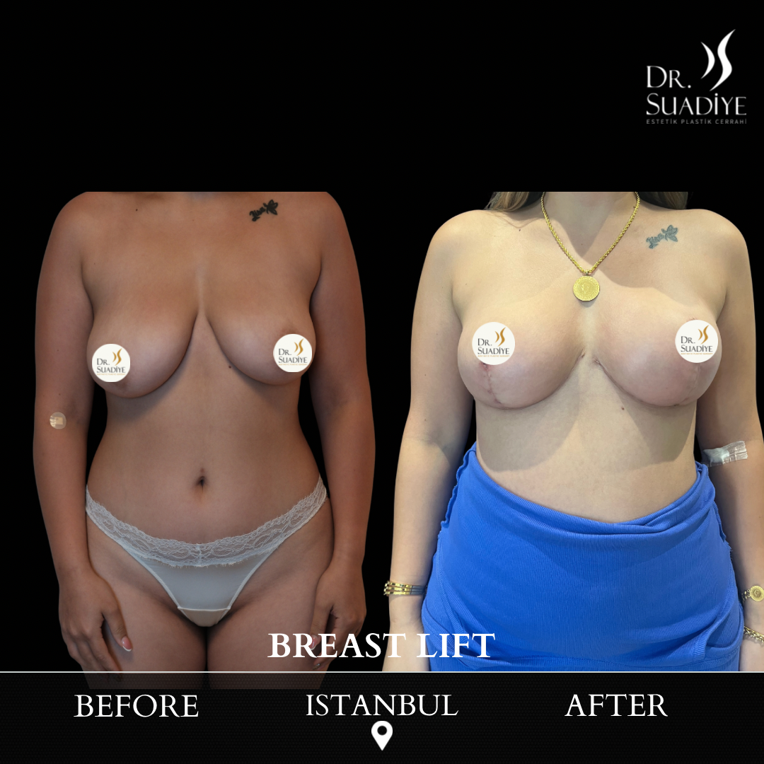Breast Lift in Turkey