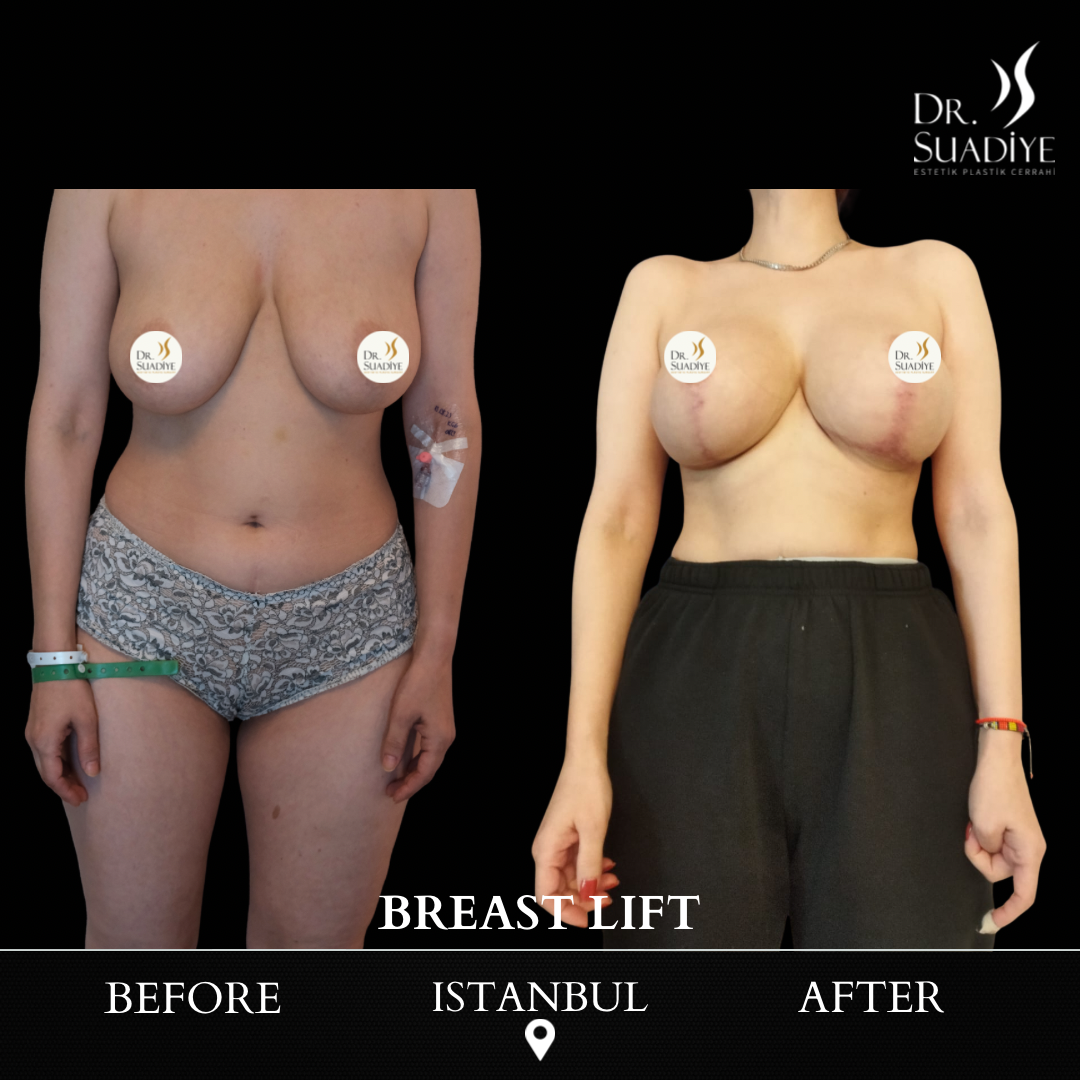 Breast Lift in Turkey
