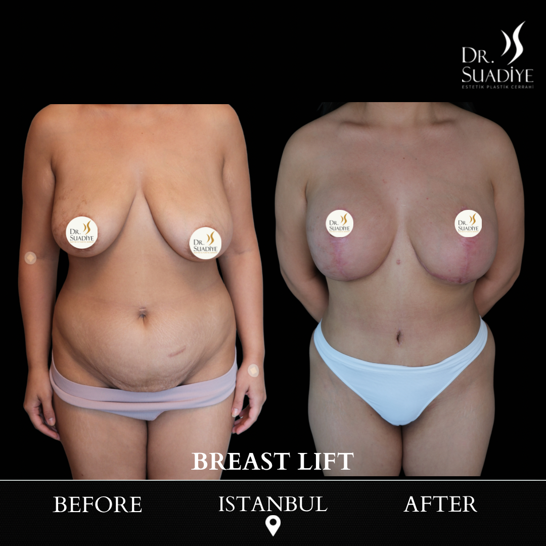 Breast Lift in Turkey
