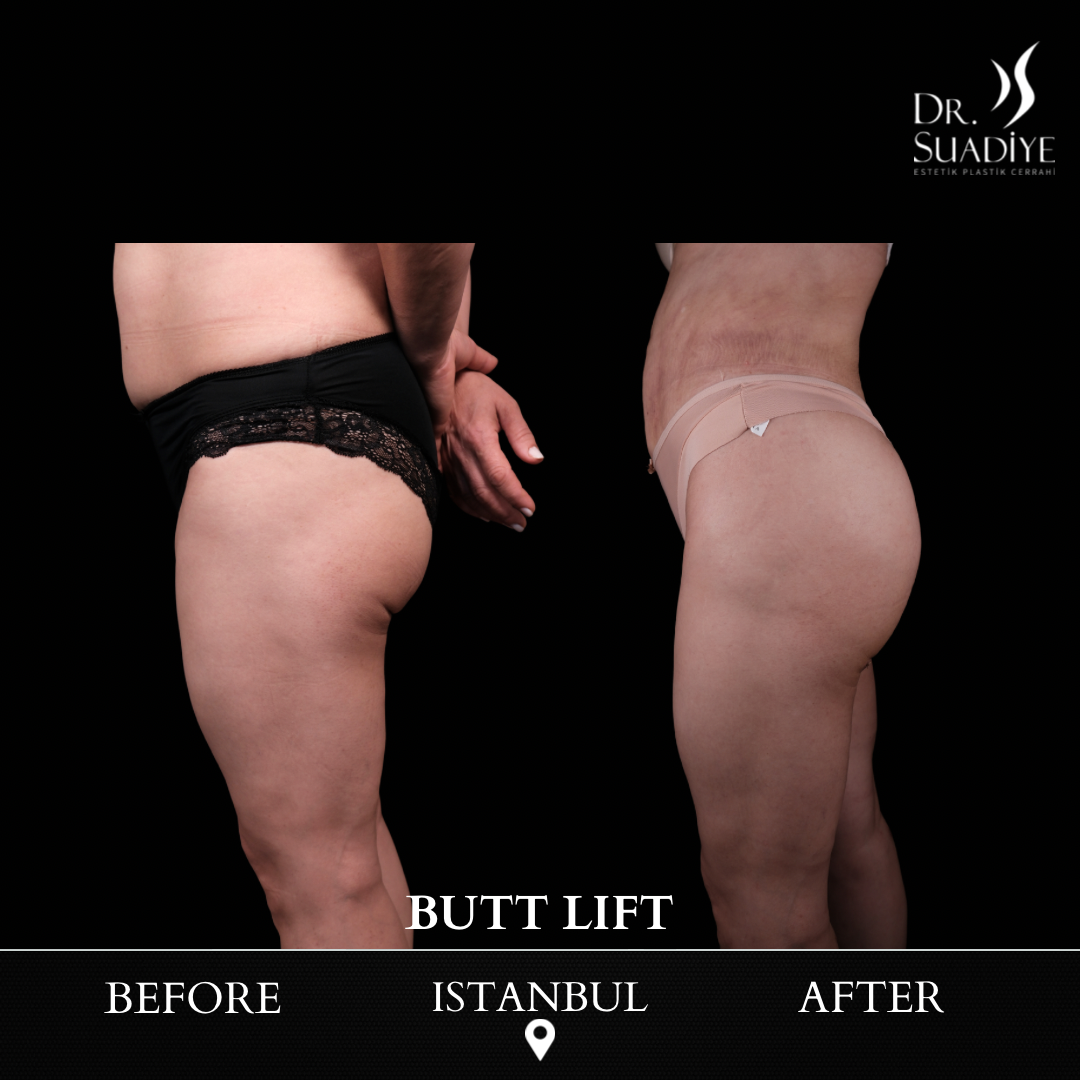 Brazillian Butt Lift - BBL in Turkey