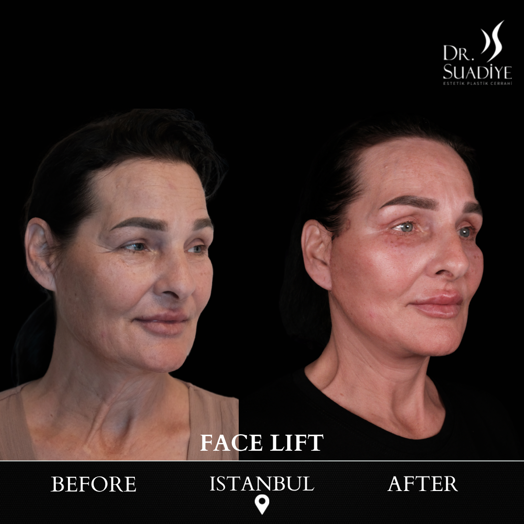 Facelift in Turkey