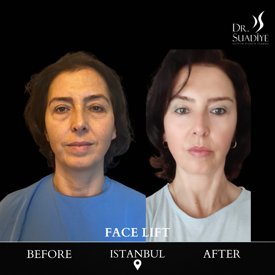 Facelift in Turkey