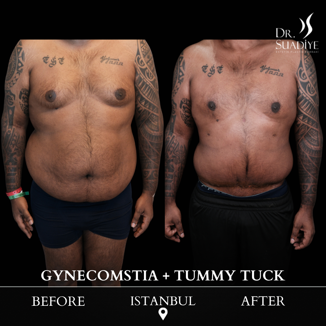 Gynecomestia in Turkey