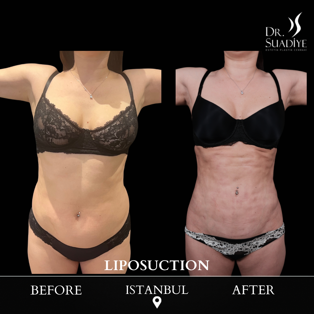 Liposuction in Turkey