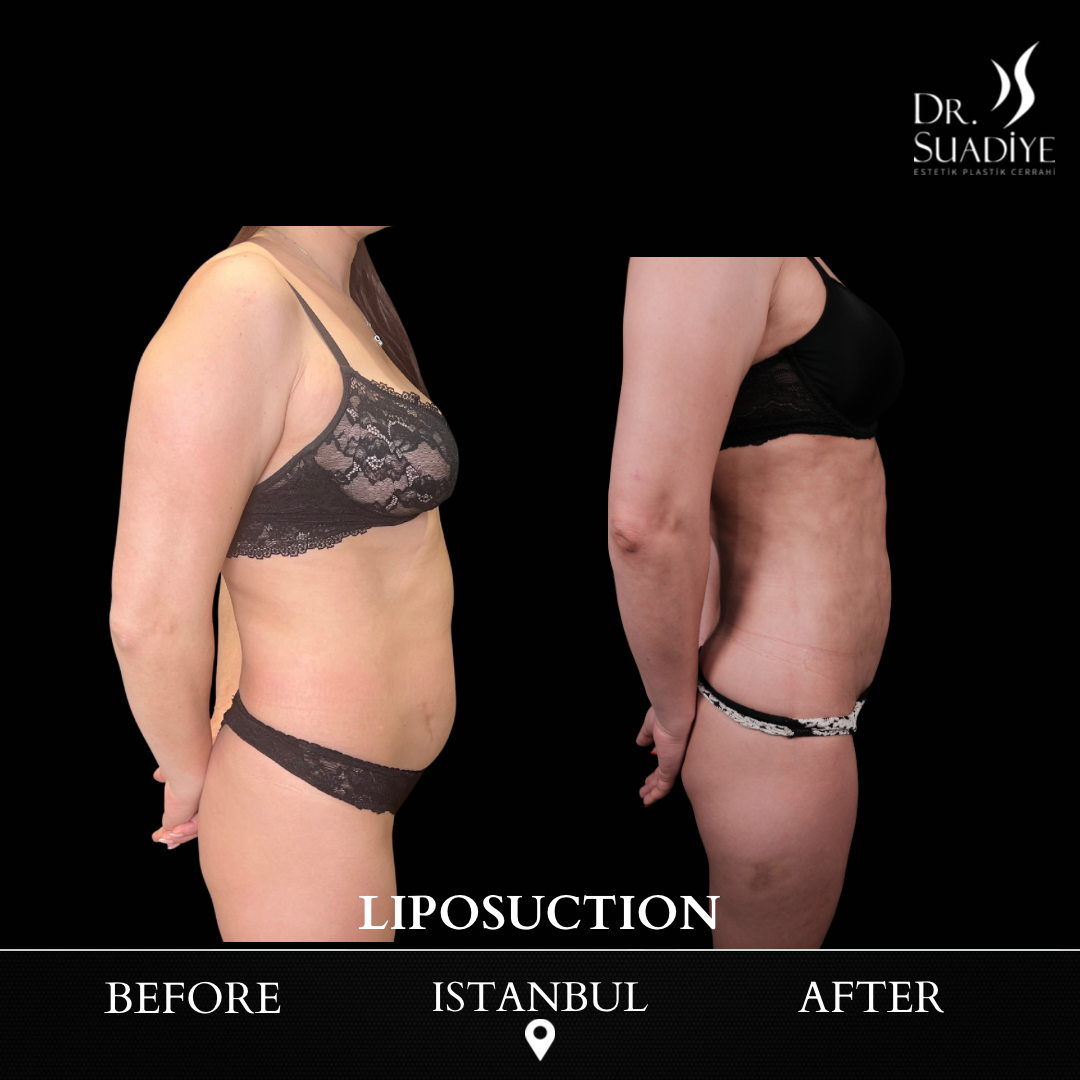 Liposuction in Turkey