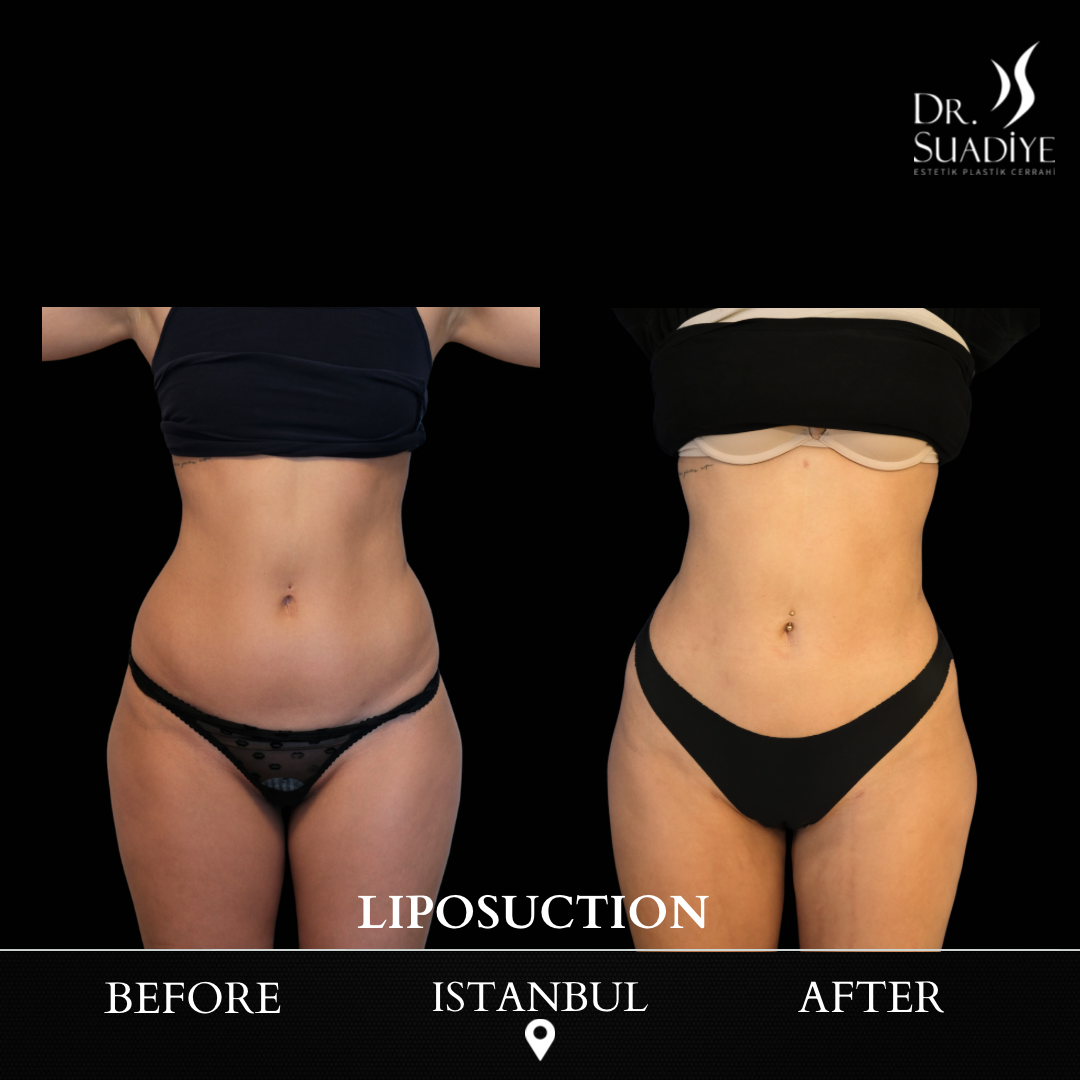 Liposuction in Turkey