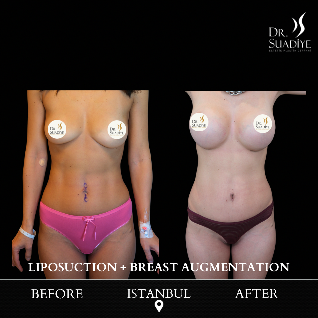 Liposuction in Turkey