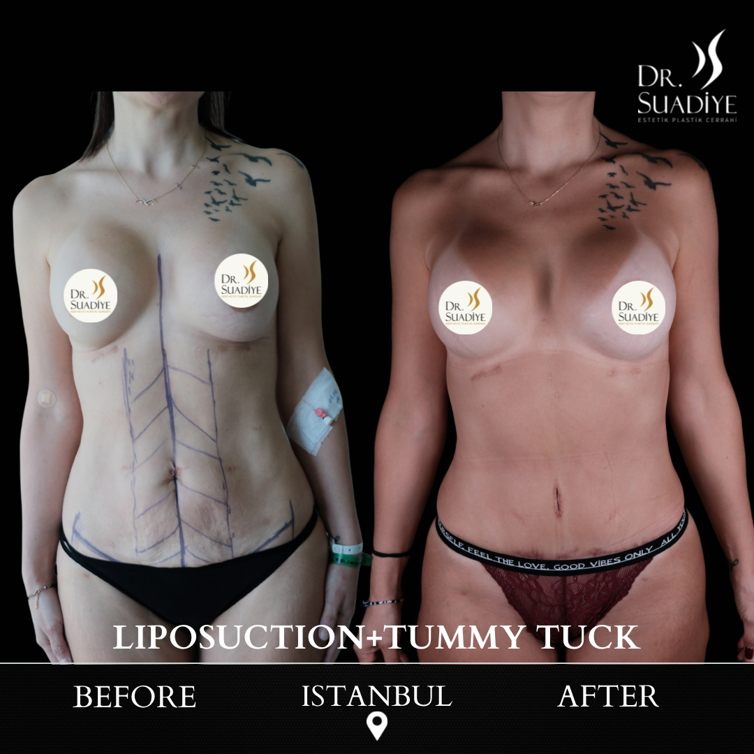 Liposuction in Turkey