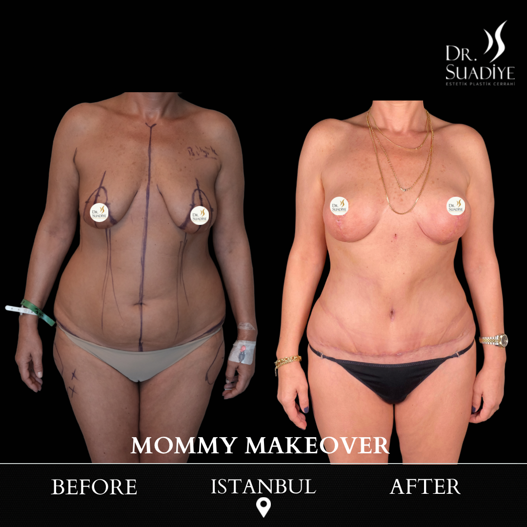 Mommy Makeover in Turkey