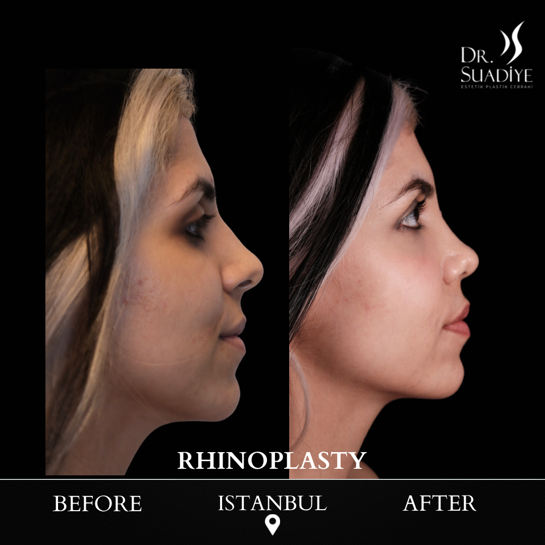 Rhinoplasty in Turkey