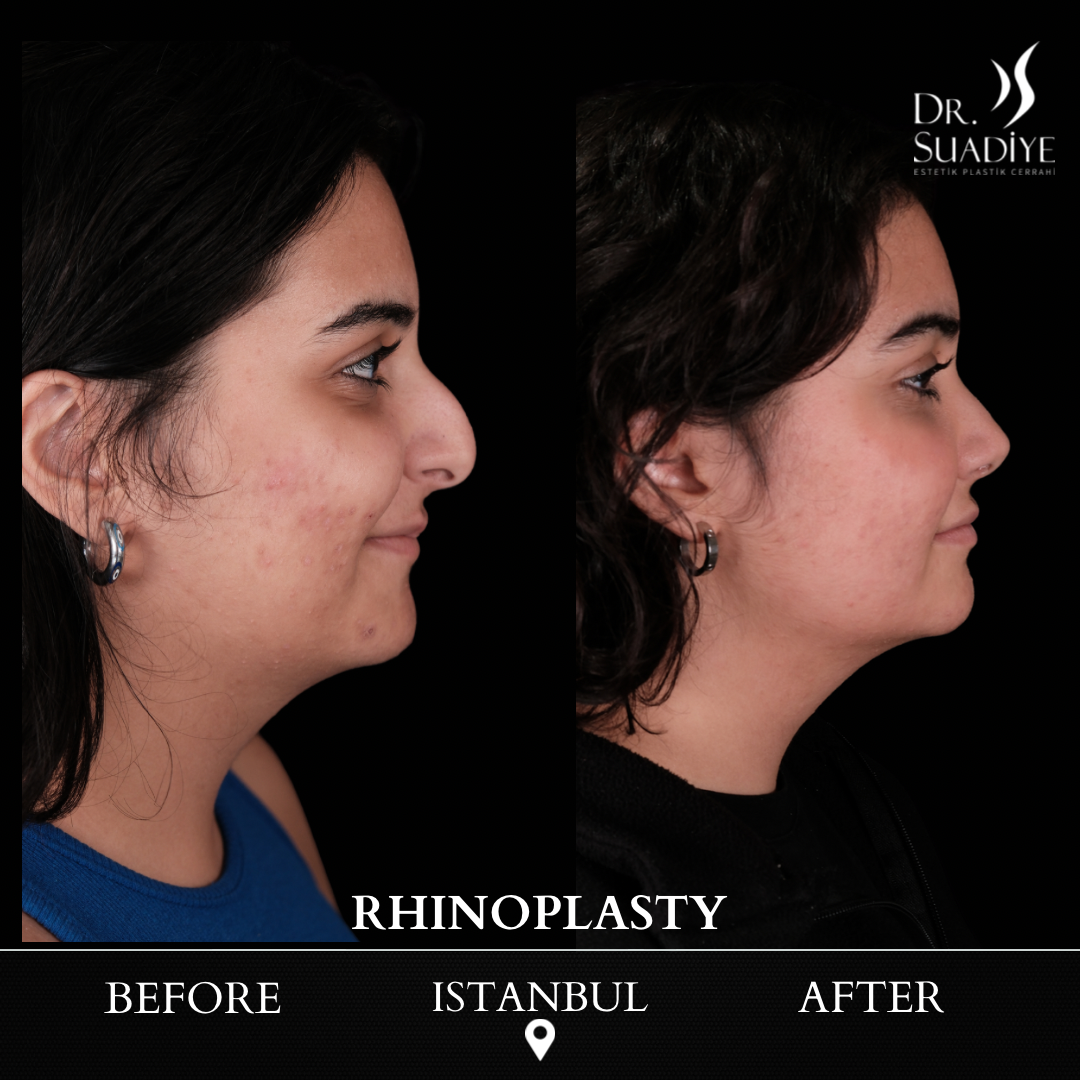 Rhinoplasty in Turkey