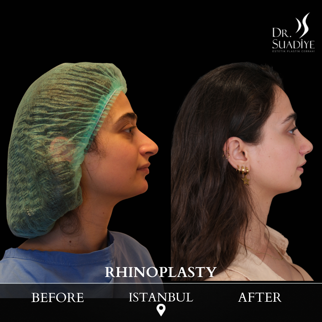 Rhinoplasty in Turkey