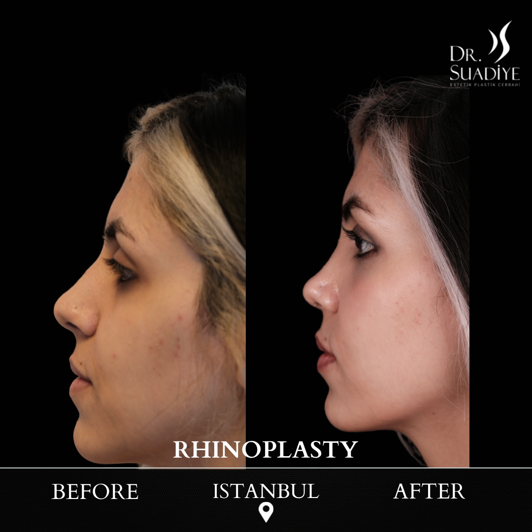 Rhinoplasty in Turkey